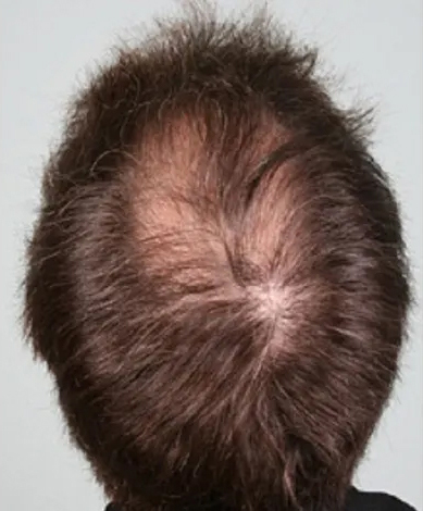 PRP Hair Restoration