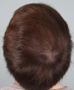 PRP Hair Restoration