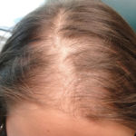 PRP Hair Restoration