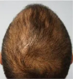 PRP Hair Restoration