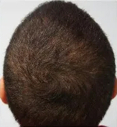 PRP Hair Restoration