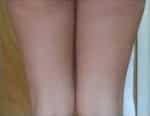 Non Invasive Fat Reduction