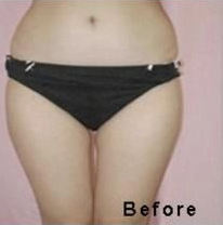 Non Invasive Fat Reduction