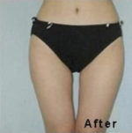 Non Invasive Fat Reduction