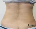 Non Invasive Fat Reduction