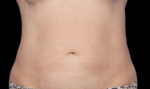 Coolsculpting