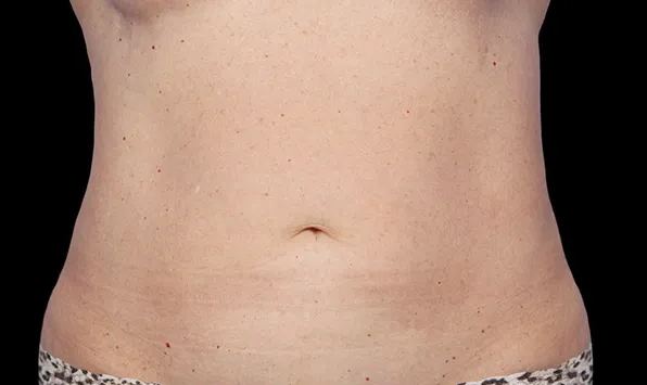 Coolsculpting