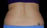 Coolsculpting