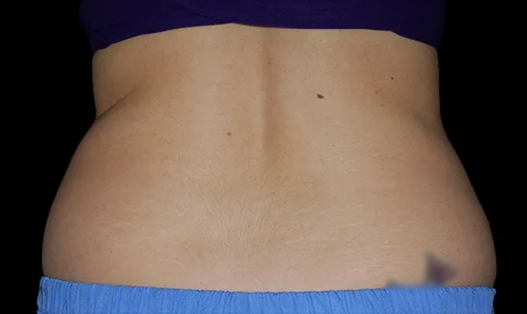 Coolsculpting