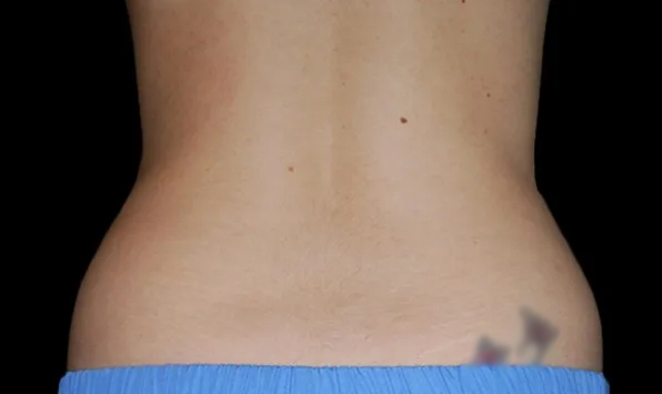 Coolsculpting