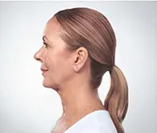 Kybella