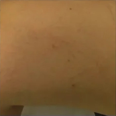 Vein Removal