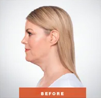 Kybella