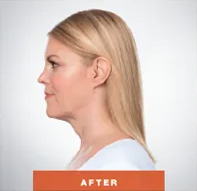 Kybella