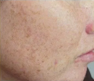 IPL Photofacial