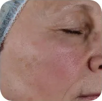 Fractional skin resurfacing