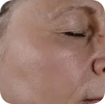 Fractional skin resurfacing