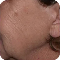 Fractional skin resurfacing