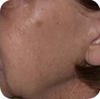 Fractional skin resurfacing