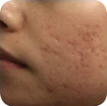 Fractional skin resurfacing