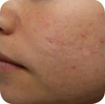 Fractional skin resurfacing