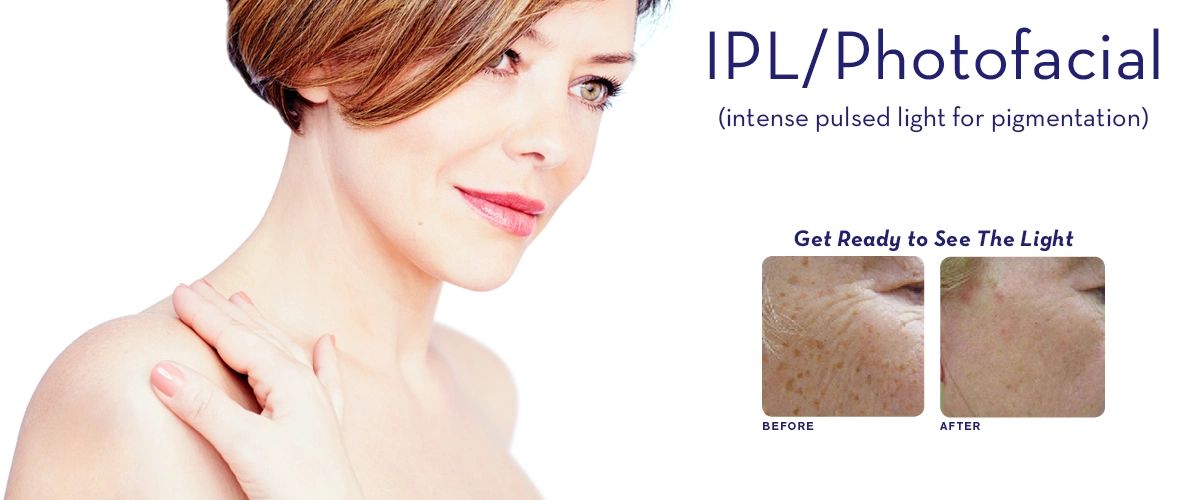 IPL Photofacial Burlington