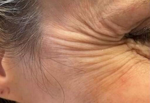 Botox