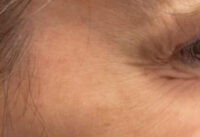 Botox