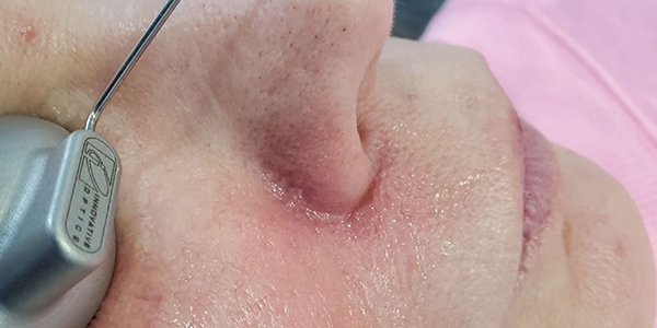 Vein Removal