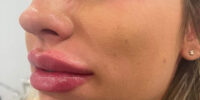 Dermal Fillers
