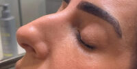 Dermal Fillers