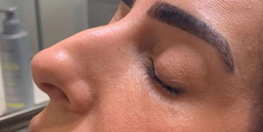 Dermal Fillers