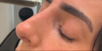 Dermal Fillers