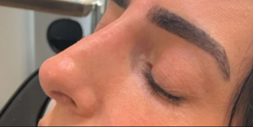 Dermal Fillers