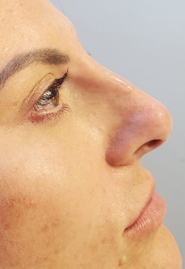 Dermal Fillers