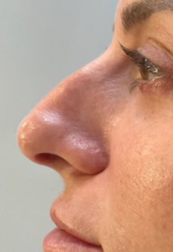 Dermal Fillers