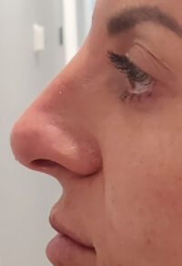 Dermal Fillers