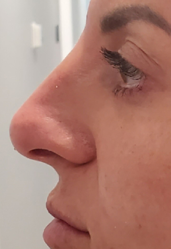 Dermal Fillers