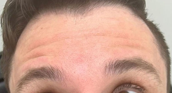 Botox