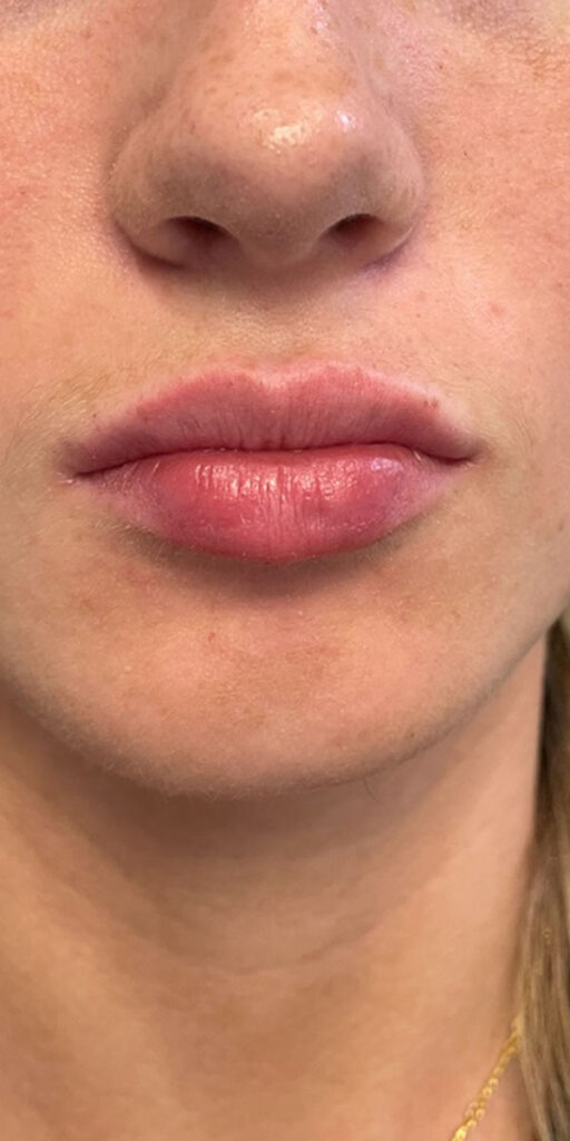 Dermal Fillers