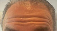 Botox