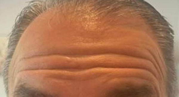 Botox