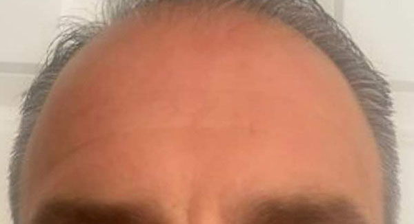 Botox