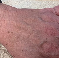 IPL Photofacial