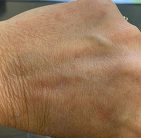 IPL Photofacial