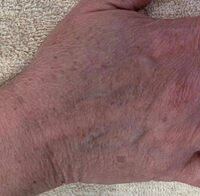 IPL Photofacial