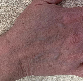 IPL Photofacial