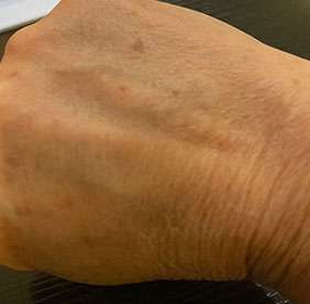 IPL Photofacial