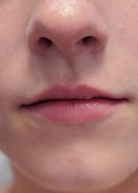 Dermal Fillers
