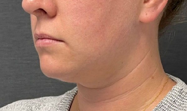 Coolsculpting